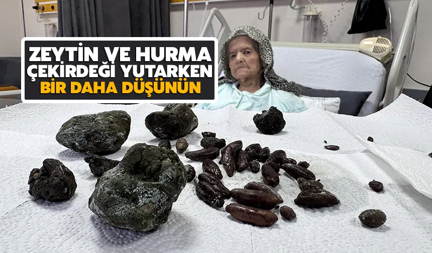 92 Yaşındaki kadının midesinden zeytin çekirdekleri çıktı!