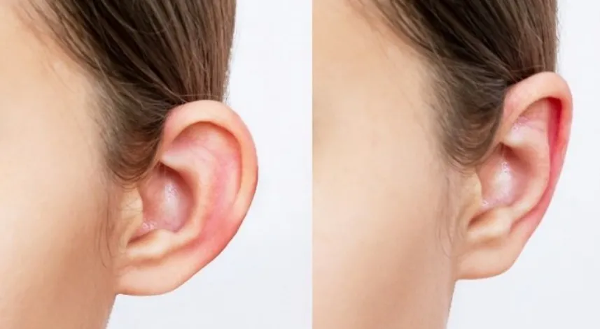 Kepçe kulak estetiği ile özgüven artıyor