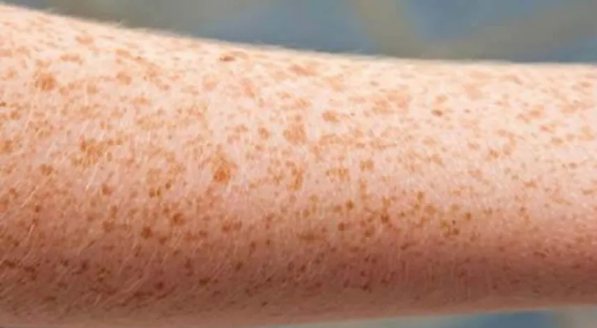 Cilt lekeleri en sık güneş hasarına bağlı nedenlerle görülür