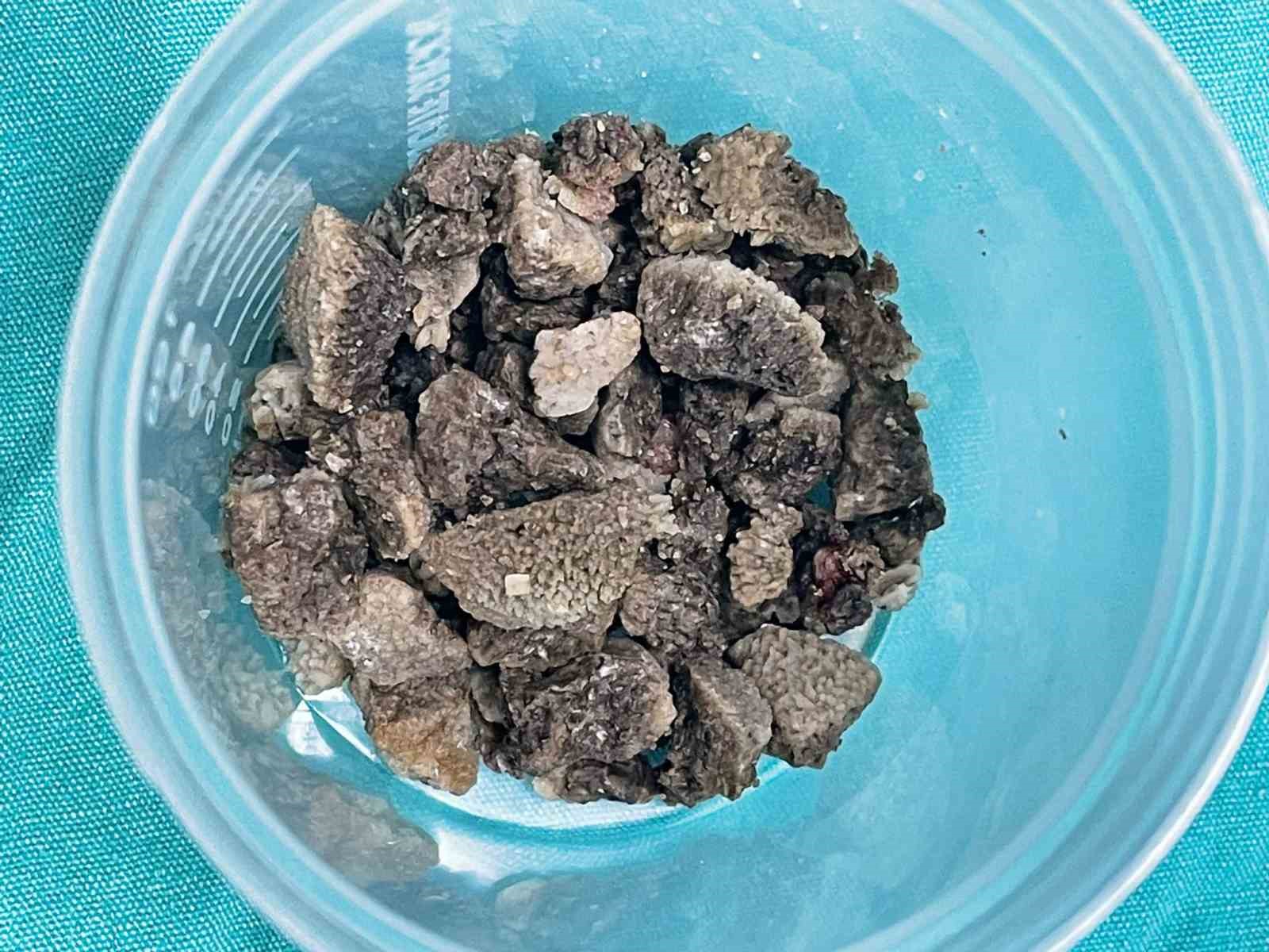 8 santimetrelik ’geyik boynuzu’ böbrek taşı kapalı yöntemle çıkarıldı