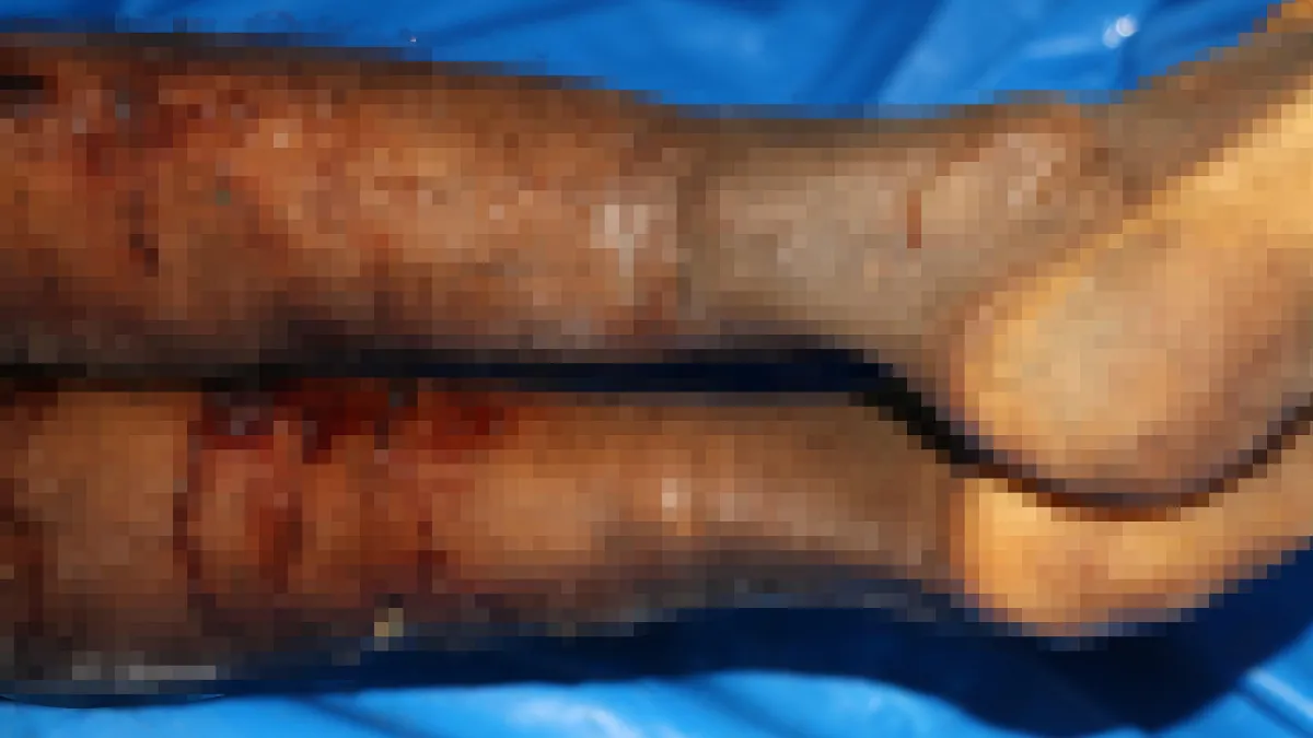 İsrail'in iade ettiği cenazelerde işkence izleri görüldü