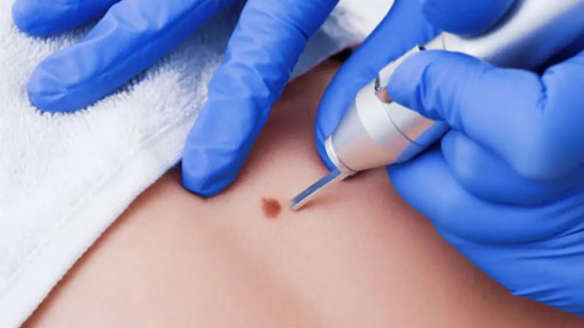 ’Ben’ler sadece cerrahi yolla çıkarılmalı