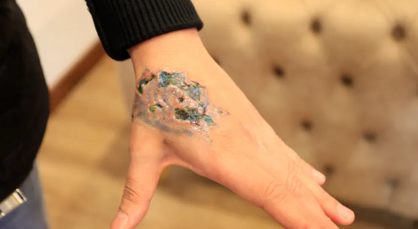 Dövme Sildirmek İsterken Kabusu Yaşadı, Elindeki Dokular Öldü