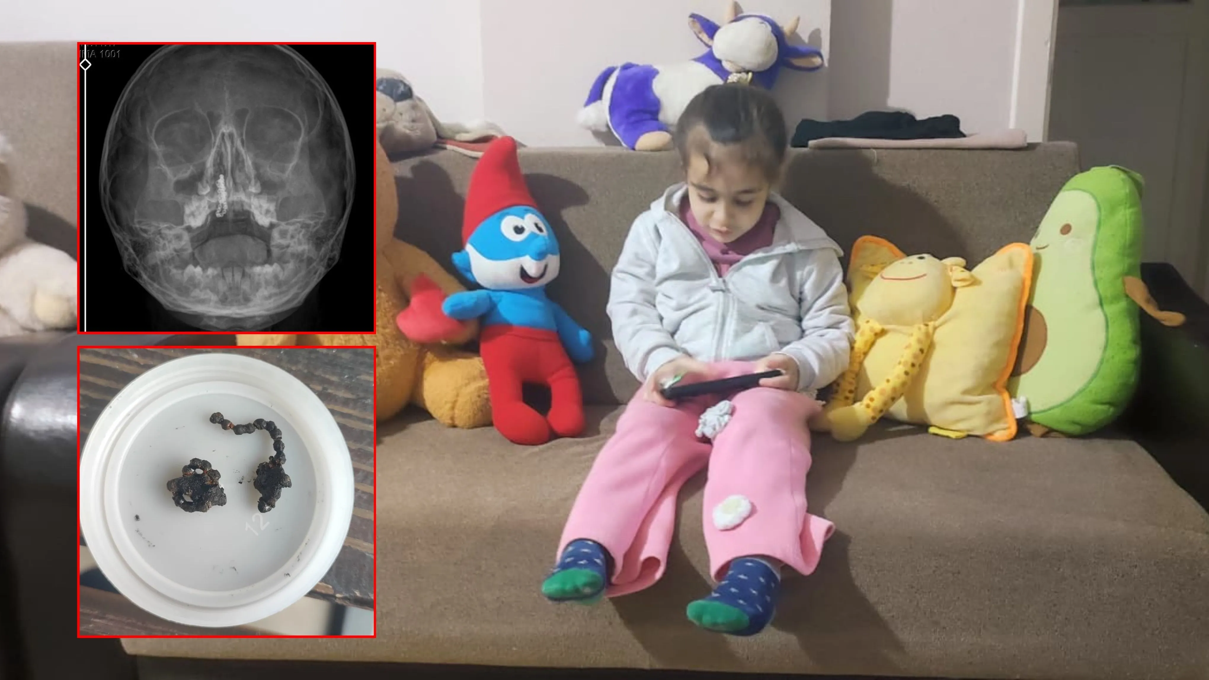 5 yaşındaki Polen, 2 yıldır burnunda tırnak makası zinciriyle yaşamış